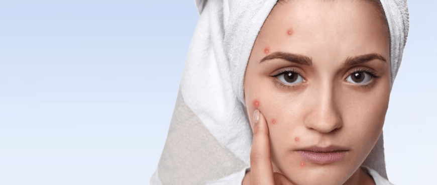 7 Effective Ways to Get Rid of Acne - JaqulineUSA